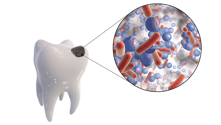 むし歯をつくる4つの要因