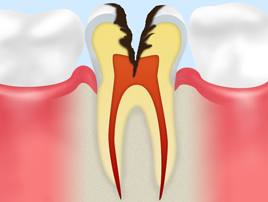 神経にまで達したむし歯（C3）
