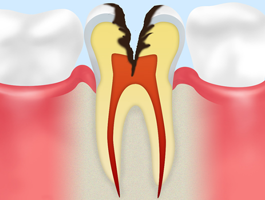 神経にまで達したむし歯（C3）