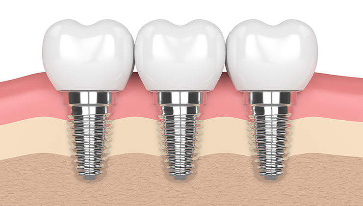 自分の歯のような見た目や噛み心地を再現