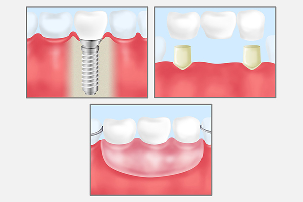 インプラントとブリッジ・入れ歯との違いについて