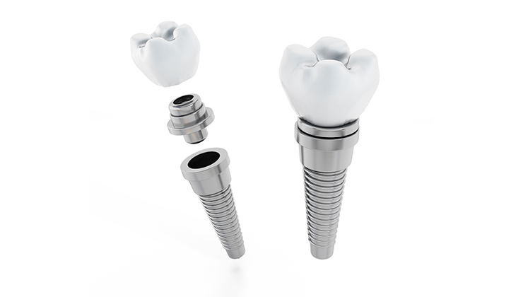 インプラント治療の流れ