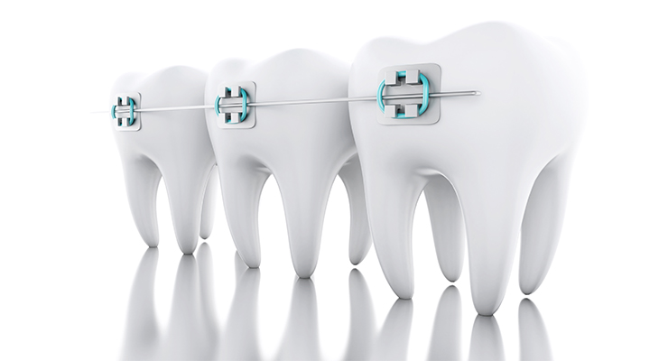 「極小ブラケット」と「透明マウスピース」で前歯の歯並びを美しく