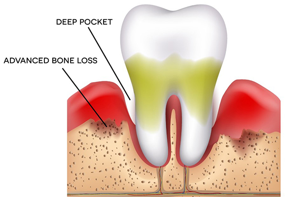 定期検診が“歯の寿命”を伸ばす