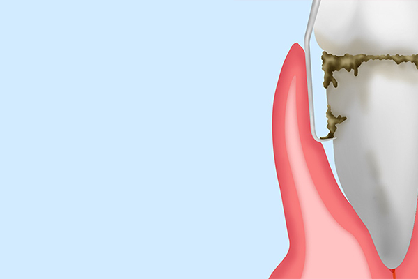 SRP（スケーリング・ルートプレーニング）