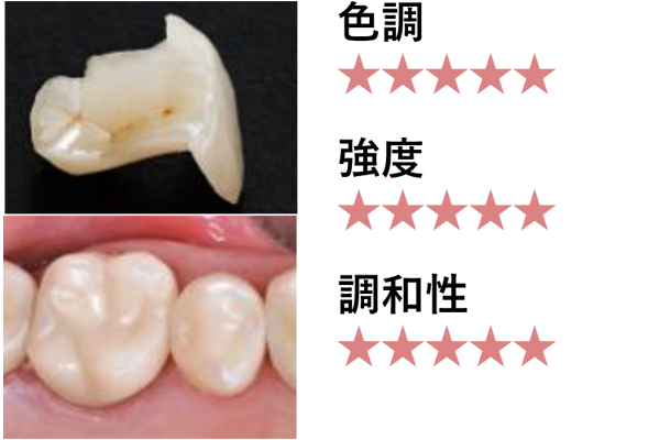 セラミックインレー