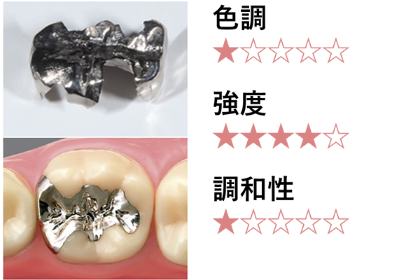 セラミックインレー