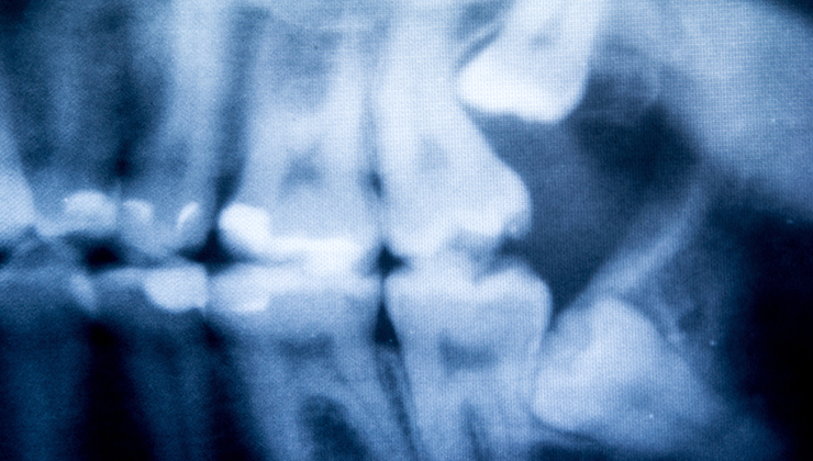 親知らずとは？